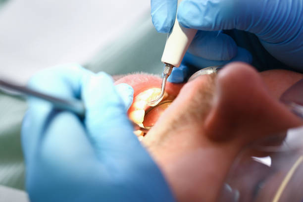 Best Emergency Gum Treatment in Georgetown, CA