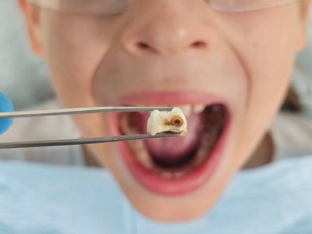 Best Emergency Dental Care for Broken or Chipped Teeth in Georgetown, CA